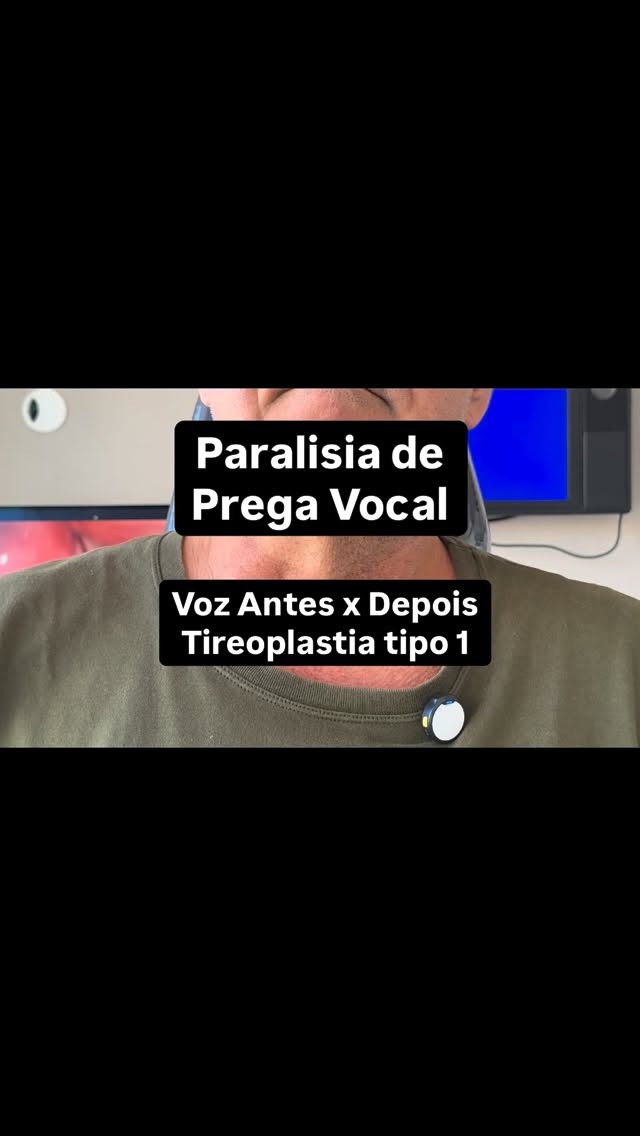 Ele fez uma cirurgia no tórax e acordou sem voz. Depois da tireoplastia, não foi só a voz que voltou — foi a autoestima, a confiança e o prazer de se comunicar com o mundo.
O nervo que controla a movimentação das pregas vocais tem um trajeto longo pelo organismo.
Por isso, cirurgias como tireoidectomia, cirurgias de coluna, cirurgia cardíaca, cirurgias de esôfago e cirurgias torácicas em geral podem lesá-lo — causando paralisia de prega vocal.
O resultado é uma voz fraca, soprosa, com esforço para falar e, em alguns casos, dificuldade para engolir.
Quais são os tratamentos cirúrgicos?
💉 Injeção medializadora da prega vocal — procedimento minimamente invasivo, pode ser feito em consultório e imediatamente após a paralisia ser detectada
🔧 Tireoplastia tipo 1 — cirurgia que reposiciona a prega vocal de forma permanente
A escolha do tratamento depende das características da voz e de cada paciente.
Diagnóstico precoce e acompanhamento especializado fazem toda a diferença no resultado.
👇 Se sua voz mudou após uma cirurgia, não hesite em passar por avaliação especializada. Estou aqui para te ajudar. Consultas pelo link na bio.