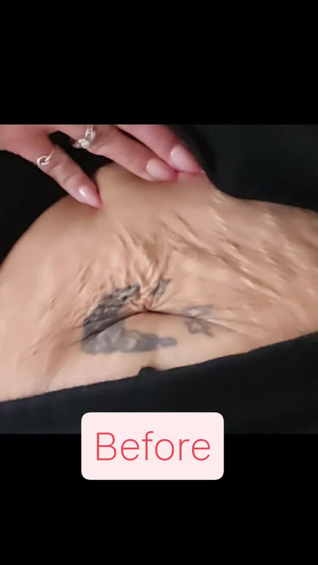 Results with Scarlet Pro Radiofrequency Microneedling! #aesthetic #smallbusiness #radiofrequencymicroneedling #scarletpro