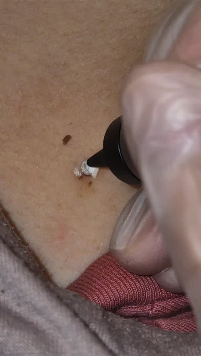 Say goodbye to the things that have been bothering you for years.
Cryotherapy is a quick, effective treatment used to remove unwanted skin lesions such as skin tags, age spots, warts, seborrhoeic keratoses and certain benign moles with minimal downtime.
Precise treatment. Minimal discomfort. Little to no scarring when healed properly.
The smallest treatments make the biggest difference to confidence.