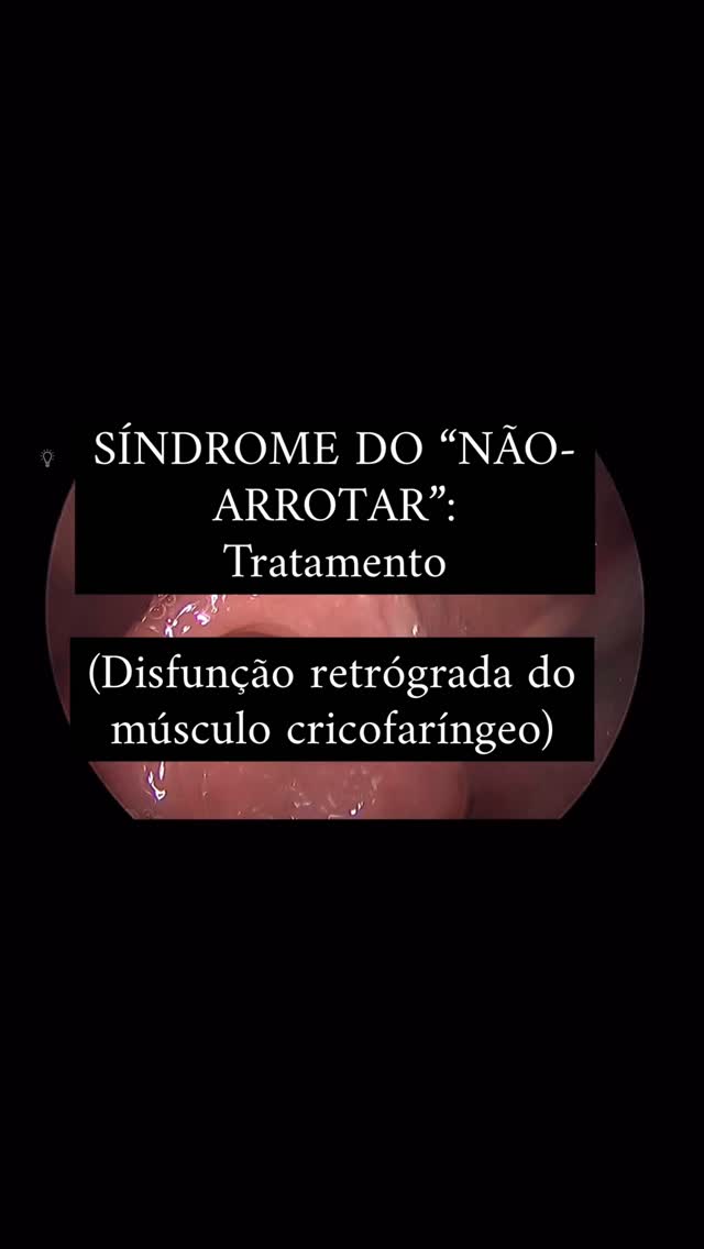 Hoje fizemos mais um tratamento da “síndrome do não arrotar”, a R-CPD (Retrograde Cricopharyngeal Dysfunction — disfunção retrógrada do músculo cricofaríngeo).
O sintoma de “não arrotar” já existia no passado, mas permaneceu sem nome e reconhecimento até 2019, quando então a RCPD foi formalizada, um mecanismo fisiopatológico reconhecido e um tratamento proposto. Até então os pacientes eram:
• Ignorados ou não levados a sério
• Diagnosticados com síndrome do intestino irritável, refluxo, ansiedade ou outras condições
• Orientados a “engolir ar” para tentar arrotar — manobra muitas vezes ineficaz
A descrição da doença foi um marco, pois os pacientes passaram a reconhecer seus próprios sintomas pela primeira vez após décadas de sofrimento sem diagnóstico.
E essa batalha ainda acontece todos os dias. O problema tem nome, causa e tratamento. Precisamos divulga-lo. Este espaço aqui existe para isso.
#rcpd #noburp #naoarrotar #laringologia #otorrinolaringologista