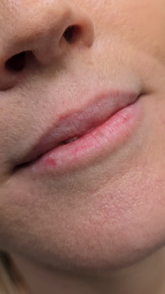 Still obsessing over these ... a total lip resurrection. 💋 If your lips disappear the second you wash your face, we need to talk. I gave this beauty a flawless, custom blush that adds instant youth and definition. The transition speaks for itself—natural, effortless, and highly addictive.
📅Book you appointment online by follow link in bio or by texting 843-499-4357.
www.charlestonpermanentmakeup.com
#lipblush #permanentmakeup #lipblushtattoo #SouthCarolina #Charleston