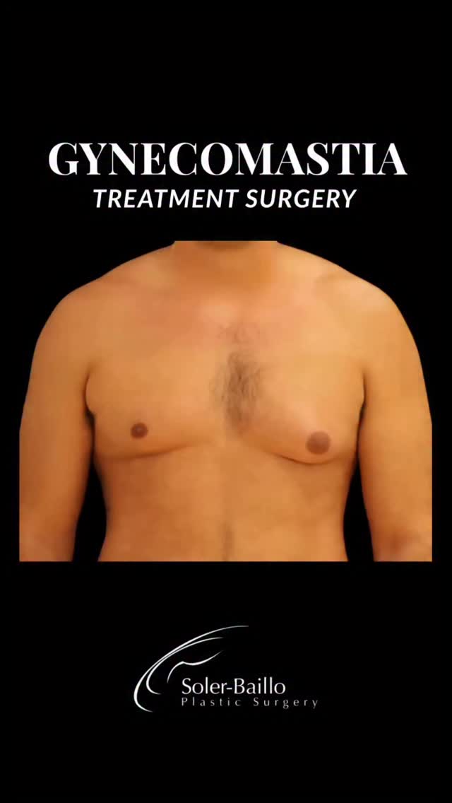 💪 Confidence restored, symmetry achieved.
This patient’s gynecomastia correction required a customized approach — removal of excess breast tissue on one side and liposuction on the other to create a more balanced chest contour. The result: improved symmetry in shape, size, and nipple position for a natural masculine appearance. ✨
Performed by Dr. Soler-Baillo.
#Gynecomastia #MaleChestContour #GynecomastiaSurgery #PlasticSurgery #MaleConfidence
