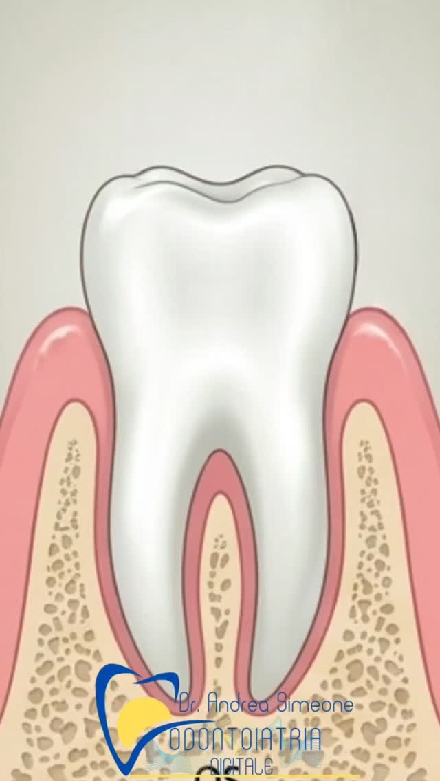 🦷 La malattia parodontale è ancora oggi troppo poco conosciuta!
Ed è proprio questo il problema.
A volte spiegarla è difficile, perché è una malattia complessa…
Per questo abbiamo creato questo video:
per mostrarvi in modo semplice e chiaro come può evolvere nel tempo, se trascurata.
💡 Capire il problema è il primo passo per prevenirlo.
Gengive che sanguinano, alito cattivo persistente o sensibilità non andrebbero mai ignorati.
📍 Nel nostro studio a Piacenza ci occupiamo anche di prevenzione e trattamento delle malattie parodontali, con un approccio personalizzato e non invasivo quando possibile.
📞 Prenota la tua visita al 0523/754242
📱 WhatsApp 329-3954960
📍 Via Giacomo Lanza, 55 – Piacenza
🌐 www.dottorsimeone.it
#parodontite #gengive #saluteorale #igieneorale #dentistapiacenza prevenzione odontoiatria
