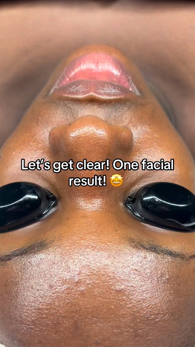 A combination of good extractions, custom peel and mask selection! Our acne and pigmentation journey continues….
#brownskin #acne #acnetreatment #rockvillemd #maryland
