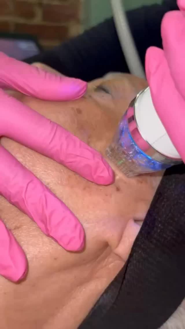 Skin, but upgraded ✨
Secret RF combines microneedling with radiofrequency to stimulate collagen production at a deeper level — helping improve fine lines, acne scars, and overall skin texture.
It’s not just about surface glow… it’s about real skin remodeling.
Smoother. Firmer. Clearer skin over time.
📲 Ready to start your transformation? DM me “RF” and let’s build your plan.
#SecretRF #SkinTightening #AcneScarsTreatment #medspanyc