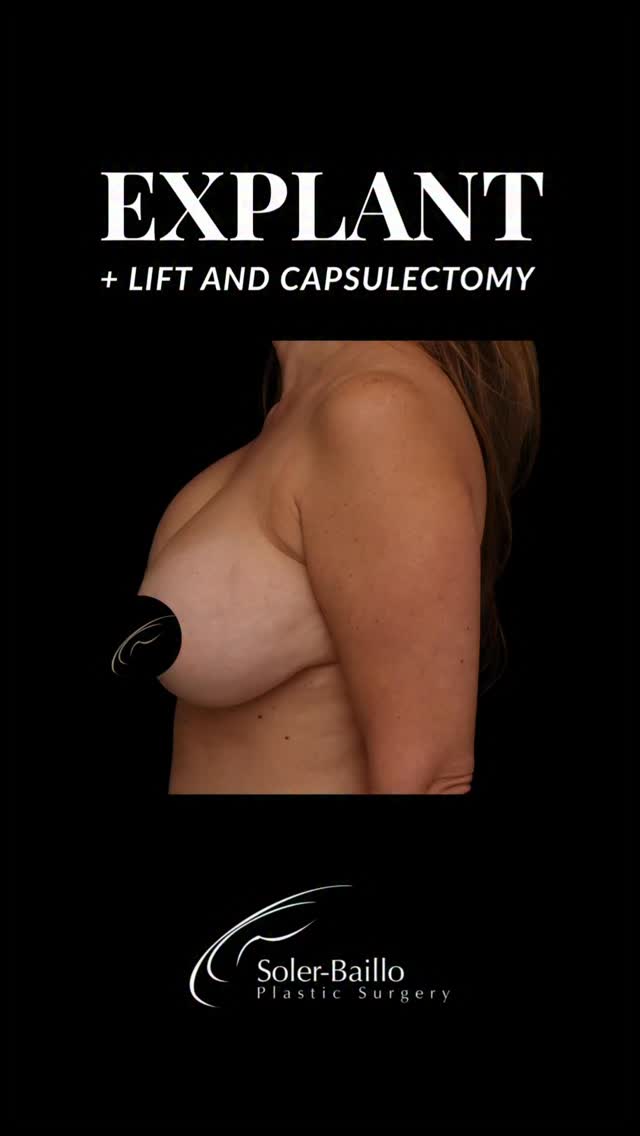 🌱 Sometimes less is more.
This beautiful transformation was achieved with an explant, capsulectomy, and mastopexy (breast lift) by Dr. Soler-Baillo. At just 6 weeks post, her shape is more lifted, balanced, and natural - and her scars will continue to soften and fade over the coming months. 💛
🧭 Ready to explore your options?
☎️ Call us at (305)661-1996
🛍️ Visit us at The Shops at Merrick Park
#ExplantSurgery #BreastImplantRemoval #BreastReconstruction #ExplantSurgeonMiami #ImplantRemovalCoralGables