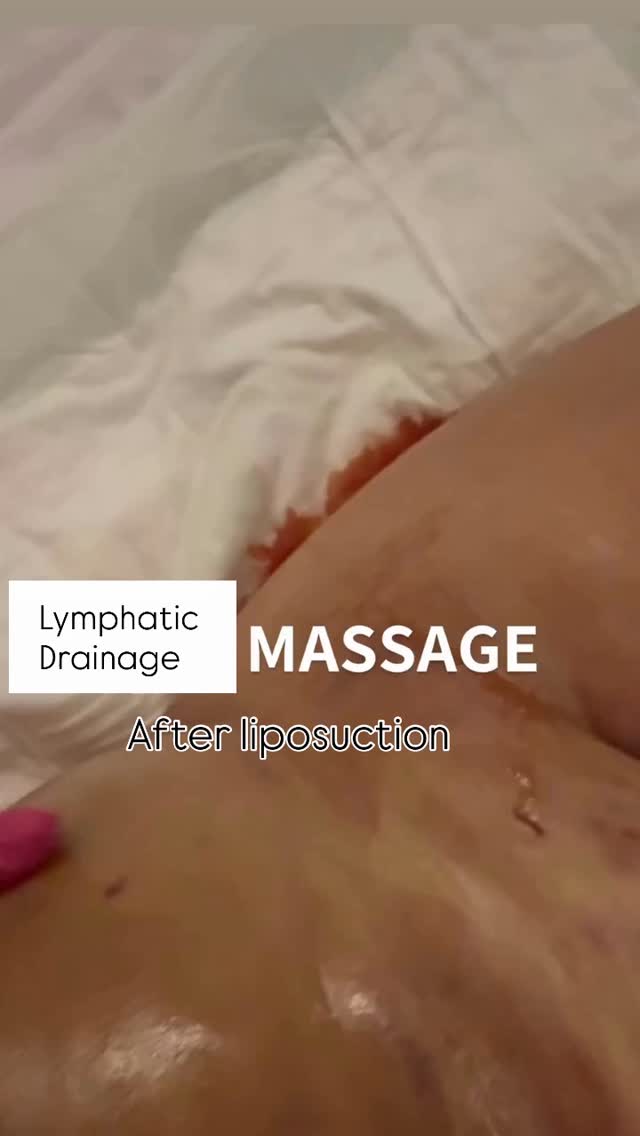 This is very important for after care liposuction.
Not get hight rick infection
#plasticsurgery #lipo #lipo360 #fatremoval #medicaltourism