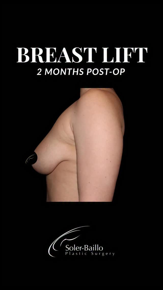 ⭐️ No implants. Just a beautifully restored shape.
This patient is only 2 months post-op from her breast lift, and her results already show improved fullness, projection, and youthful positioning following the changes of pregnancy and breastfeeding. Even better? The scars will continue to fade and mature over the coming months. ❤️🩹
Considering a breast lift? You may be surprised what’s possible without implants.
📍Coral Gables, FL
📱305-661-1996
#BreastLiftCoralGables #MastopexySurgeon #MastopexyMiami #BreastLiftNoImplants #NaturalBreastLift