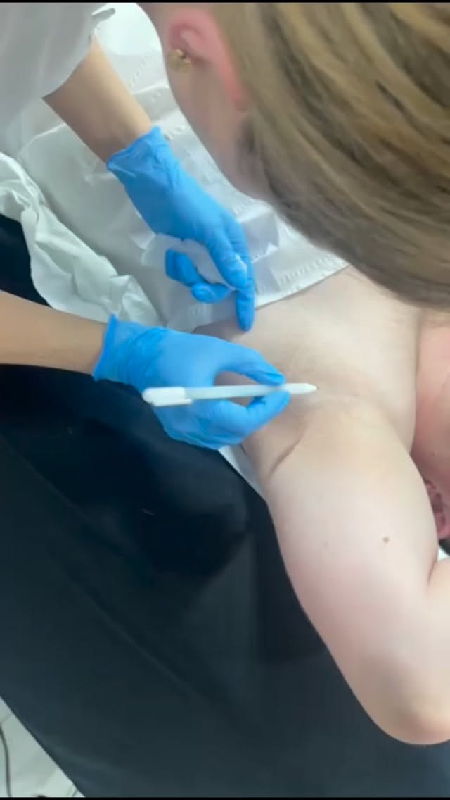 💧 MASTER HYPERHIDROSIS TREATMENTS 💧
Excessive sweating can have a profound impact on confidence, daily activities, and quality of life. As demand for effective, non-surgical solutions continues to grow, hyperhidrosis treatment is becoming an essential addition to every advanced aesthetic practitioner’s skill set.
Our Hyperhidrosis Training Programme provides comprehensive, hands-on education covering:
✨ Understanding the causes and diagnosis of hyperhidrosis
✨ Patient assessment and consultation protocols
✨ Safe and effective treatment techniques
✨ Treatment planning and dosing strategies
✨ Managing expectations and achieving optimal outcomes
✨ Legal, ethical, and professional considerations
✨ Building a profitable treatment offering within your clinic
By adding hyperhidrosis treatments to your portfolio, you can:
✔ Expand your service menu
✔ Increase client retention
✔ Attract a wider patient demographic
✔ Generate recurring revenue opportunities
✔ Deliver life-changing results that significantly improve patient confidence
Invest in your professional development and position yourself at the forefront of advanced aesthetic medicine.
📩 Message us to secure your place on our next training date.
#HyperhidrosisTraining
#AestheticsTraining
#AdvancedAesthetics
#AestheticPractitioner
#skiinpro