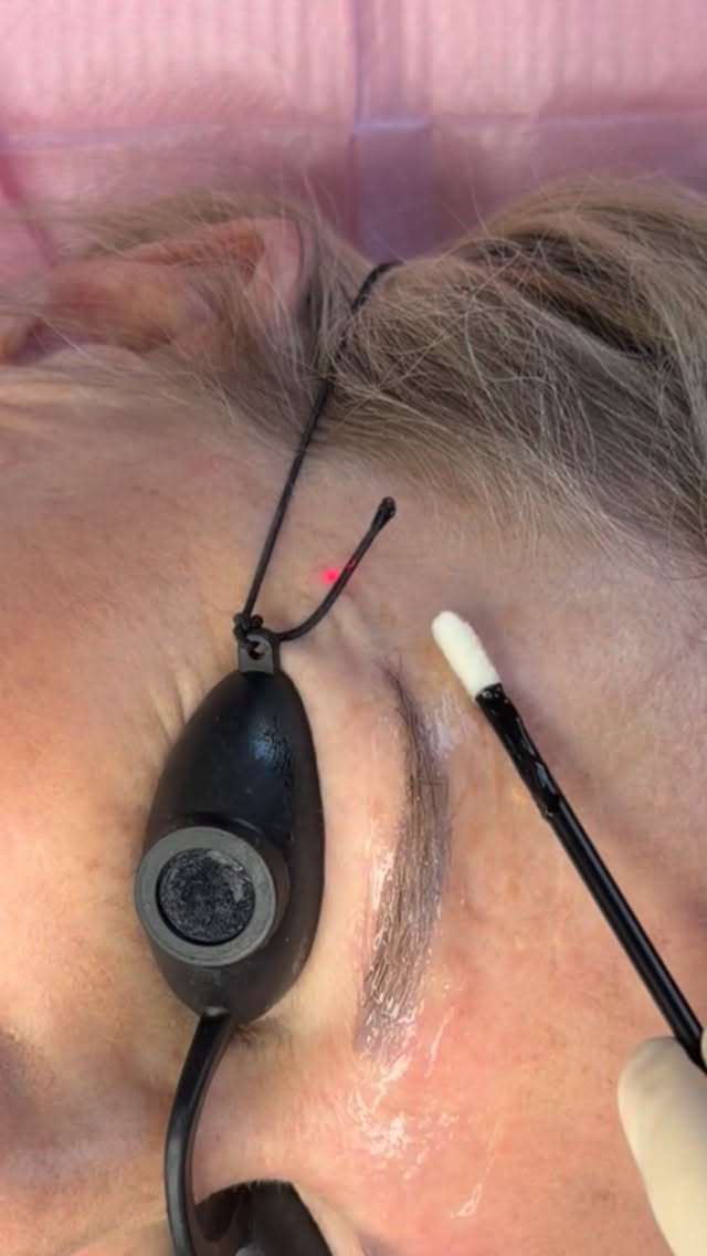 💁♀️who say the laser removal I painful???🤩🤩 check this out!!! #browtattooremoval #laserremoval #tattooremoval #newbrows #tattoobrowremovalwellington