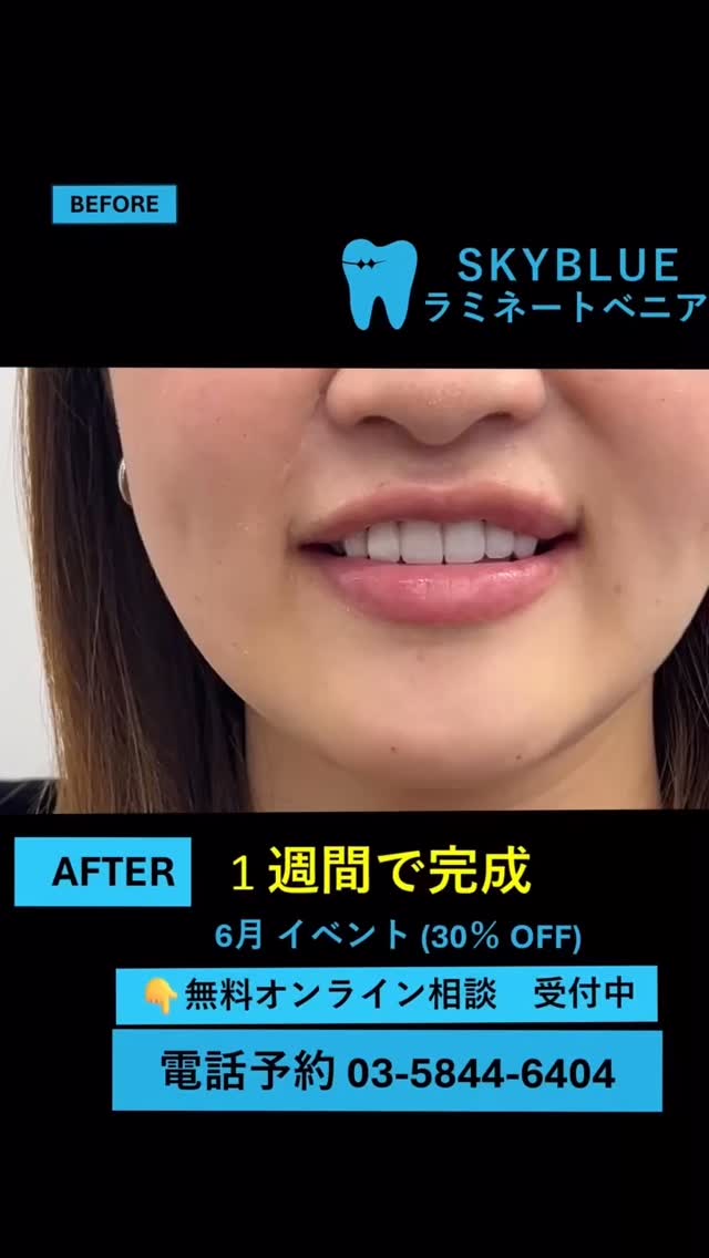 \🎁1本53900円、追加料金なし!!🦷日本で受けられるラミネート治療!/
SKYBLUEラミネートべニアで若返り:)
※6月30日までご来院の方対象│30%割引実施中✨
「前歯の形を整えたい」
「短期間で歯列を改善したい」
「ホワイトニングでも白くならない歯が悩み…」
そんな方は、
SKY BLUE歯科のラミネートで
自然歯への負担に配慮しながら、
自信の持てる口元を目指してみませんか?
【📝モニター価格適用条件】
1. Before&After撮影同意
2. 院内コンテンツ撮影同意
※お顔はモザイク処理を行います
20代 女性
治療期間 10日(最短7日で可)
治療費用 1本46200円×6本
考えられる副作用 ベニアが割れる・剥がれるの可能性、虫歯・歯周病のリスク、歯の神経へのダメージの可能性
#ラミネートベニア #無削除ラミネート #審美