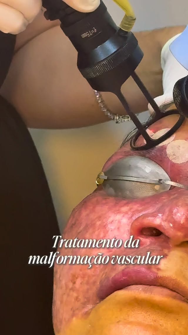 As malformações vasculares não são apenas uma questão estética. Elas são alterações dos vasos sanguíneos ou linfáticos que podem estar presentes desde o nascimento e se manifestar de diferentes formas ao longo da vida.
Em alguns casos, permanecem estáveis; em outros, podem crescer, causar desconforto, dor, sangramentos e impacto significativo na qualidade de vida.
O diagnóstico correto é fundamental para definir o melhor tratamento. Hoje contamos com tecnologias como lasers, sempre individualizadas para cada paciente.
Quanto mais precoce a avaliação especializada, maiores são as possibilidades de controle e melhores os resultados alcançados.
Clique no link da bio e descubra como podemos te ajudar!
Dr Emmanuel França
Dermatologista
CRM 5999
RQE 636
📍Skin Prime - Riomar Trade Center - Torre 3 - Sala 1905
☎️ (81) 3036-4040