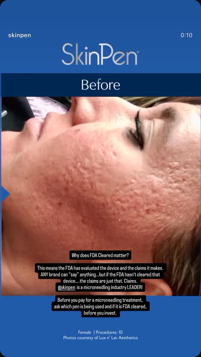 Support your skin where it matters most, because healthy-looking skin starts with supporting what’s already within.
@SkinPen activates your skin’s natural regenerative process to help improve the appearance of facial acne scars and neck wrinkles over time.
Renewed skin starts with only one 60-minute session, with optimal results after 3 or more sessions.
Contact us for more information. 💃🏻 🕺🏻
Call/Text 425-879-2660
www.glowskinscience.com
(Link in bio. )
#SkinPen #Microneedling #SkinPenMicroneedling #AcneScars acnefreeskin