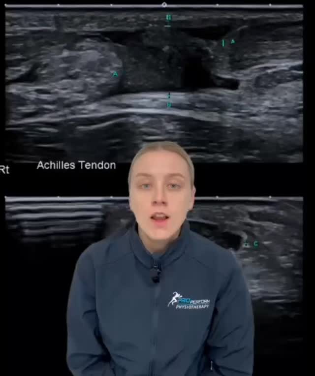 Ever wondered what an Achilles tendon rupture actually looks like? π
Jess walks us through a real patient case, breaking down the ultrasound findings and whatβs happening inside the tendon.
π 3/3 Trappers Drive, Woodvale 6026
π Book online: www.properformphysio.com
π² (08) 9309 3166
π·οΈ @properformphysio in your posts to share your journey with us!
#physio #physiotherapy #ProPerformPhysio #sportsphysio #Achilles