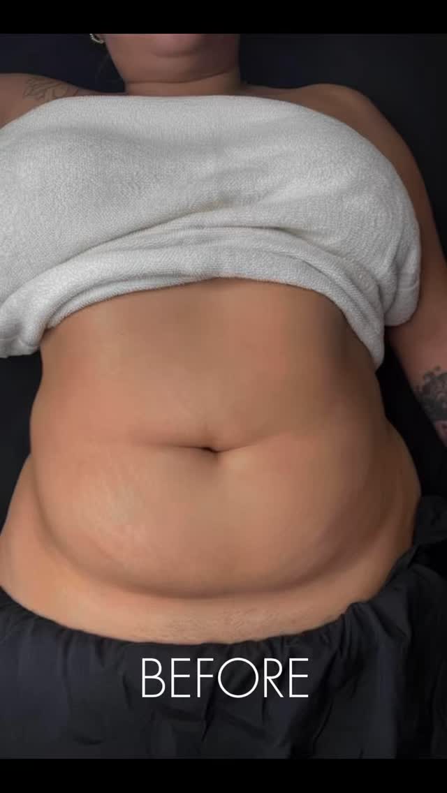 POV: Your vacation starts before you get on the plane ✈️
Because feeling light, sculpted, and confident is the best thing to pack
#lymphaticdetox#lymphaticsystem#lymphatichealth#lymphatictreatment