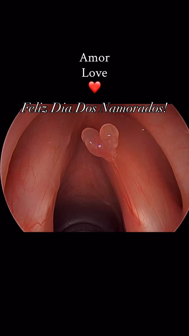 Feliz dia dos namorados no Brasil!
Na foto, um pequeno pólipo de prega vocal direita em formato de coração.