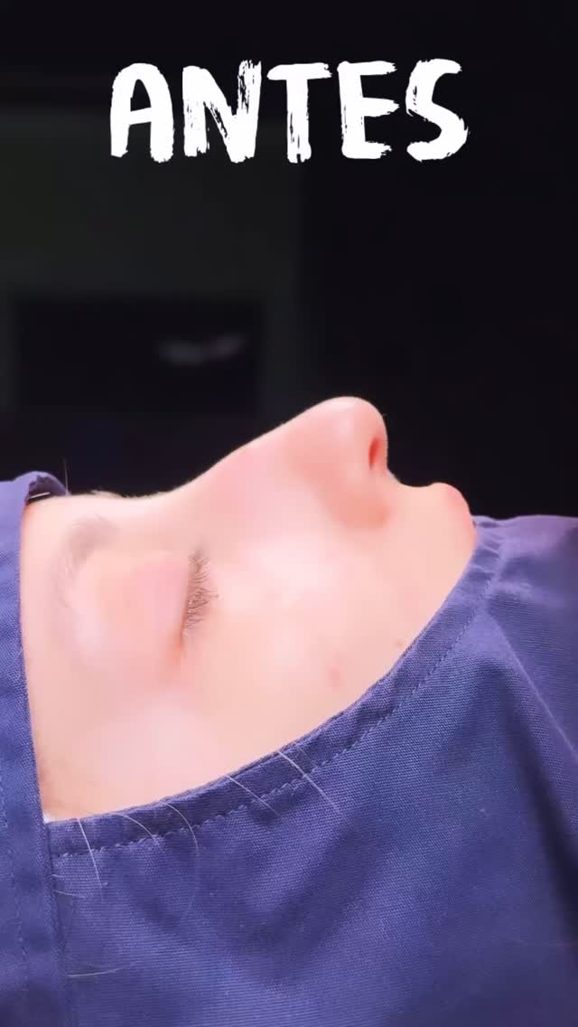 🔹Cada procedimiento es personalizado, planificado con precisión y ejecutado con técnica y experiencia. La Rinoplastia es arte y ciencia combinados.
🔹Resultado inmediato Rinoplastia Estética y Funcional.
🔹 Gracias a mi excelente paciente por su confianza y permitir compartir su resultado.
🔹”Made by hand. Crafted with passion”
🧑⚕️ Dr. Guillermo Guerra Gil de Leyva
🏥 Hospital Ángeles Valle Oriente
📱 81-1252-0132
🎓Universidad de Monterrey
👃 Rinoplastia Estética y Funcional
🚫 No taponamiento
Cédula Profesional: 3070499
Cédula Especialista: 4503273
No. Certificación CONACEM: GUG-1748/04
Aviso de Publicidad COFEPRIS: 2419032002A00111
❕Paciente autoriza difusión de imágenes con fines académicos e informativos.
❕Los resultados finales se pudieran observar hasta un año de la cirugía y dependerá tanto del compromiso del cirujano como del paciente, así como del tipo de cirugía, tipo de piel, cuidados post-operatorios, etc.
#CirugíaFacial #RinoplastiaEspecializada
#rinoplastia #rhinoplasty #septoplastia septoplasty rinoseptumplastia rhinoseptoplasty nosejob nose nosesurgery tabiquenasal otorrinolaringologia entsurgery cirugianasal cirugiatabique cirugiaesteticanasal
belleza confianza autoestima
cosmeticsurgery
otorrinolaringologiamonterrey otorrinomonterrey beforeandafter antesydespues
estructuredrhinoplasty
rinoplastiaestructurada
rinoplastiaultrasonica
ultrasonicrhinoplasty
