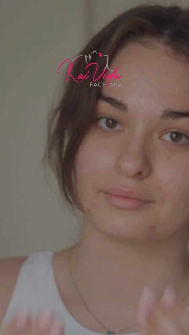 ✨ GIVE YOUR TEEN THE CONFIDENCE OF CLEARER SKIN ✨
Acne can affect more than just skin—it can affect confidence, photos, social events, sports, and everyday life.
At Kai Vida Face Spa, we take a different approach.
Instead of harsh treatments that can leave skin irritated, dry, or damaged, our customized acne treatments focus on supporting the skin while targeting breakouts at the source.
Our treatments may include:
💙 Blue LED Light Therapy to help reduce acne-causing bacteria and calm inflammation
✨ Gentle Sonic Skin Scrubber Extractions to deeply cleanse pores without unnecessary trauma to the skin
🌿 Customized treatment plans tailored to your skin concerns
📸 Real clients. Real results.
DM us the word “ACNE” to get 20% OFF our acne treatments
Whether you’re preparing for the next school year, college move-in, senior photos, sports season, or simply want healthier skin, now is the perfect time to start building confidence from the inside out.
Because clear skin isn’t about perfection.
It’s about feeling comfortable in your own skin. 🤍
📍 Chester, NJ
📞 (973) 878-0729
#KaiVidaFaceSpa #acne #chesternj
#IloveChester #mendhamnj