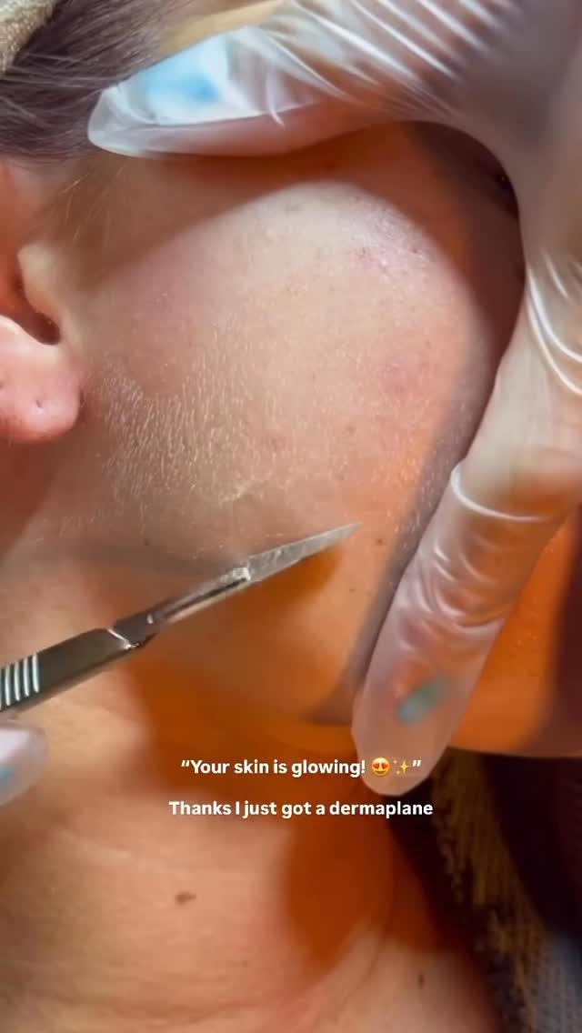 ✨ Looking for an instant, lit-from-within glow? Let’s talk about Dermaplaning! ✨
If you’re looking for a quick, non-invasive way to completely refresh your skin with zero downtime, this treatment is about to be your new best friend.
What exactly is Dermaplaning? 🤔
Think of it as the ultimate exfoliation session. One of our trained medical estheticians uses a sterile, medical-grade blade to gently glide across your skin.
It does two amazing things at once:
* Removes dead skin cells: Gently sweeps away the dry, dull outer layer of skin that builds up over time.
* Says goodbye to peach fuzz: Removes the fine vellus hair that can trap dirt and oil.
The Benefits (Why we’re obsessed):
* 🌟 Instant Radiance: You’ll walk out of Oasis Med Spa with immediately brighter, smoother skin.
* 💄 Flawless Makeup: Without dead skin and peach fuzz, your foundation will glide on like absolute silk.
* 🧴 Supercharged Skincare: Your favorite serums and moisturizers will finally absorb directly into your skin instead of sitting on top of dead cells.
🚫 Myth Busting Time!
“Will my hair grow back thicker or darker?”
Nope! It’s physiologically impossible for vellus hair (peach fuzz) to grow back like coarse terminal hair. It will grow back exactly the same—soft and fine.
📅 Ready for your ultimate glow-up?
Spaces fill up fast! Click the link in our bio or DM us to book your Dermaplaning facial today. Let’s get you glowing! ✨
#OasisMedSpa #Dermaplaning #GlowSkin #SkincareRoutine #MedSpaLife Esthetician HealthyGlow Exfoliation SelfCare✨