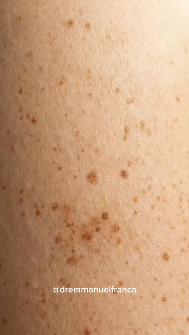 Você não vê. Sua pele sente.
Toda vez que a pele é exposta ao sol sem proteção, os raios UV estimulam os melanócitos a produzirem mais melanina como um mecanismo de defesa. O problema é que, com a exposição repetida, essa produção deixa de ser uniforme. Algumas áreas acumulam mais pigmento do que outras, favorecendo o surgimento de manchas, sardas e sinais do fotoenvelhecimento.
Mas os efeitos vão além do que aparece no espelho. A radiação solar também degrada colágeno, elastina e causa danos ao DNA das células da pele, aumentando o risco de câncer de pele ao longo do tempo.
O filtro solar não impede você de viver o sol. Ele ajuda sua pele a se defender dele.
Sua pele lembra de cada minuto de exposição. Proteja-a todos os dias.
Dr Emmanuel França
Dermatologista
CRM 5999
RQE 636