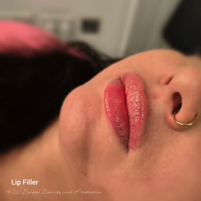 Lip Filler; Natural Enhancing
#lipfillerinbristol #fillersinbristol #dermalfillerinjections #bristollipfiller
Choosing the right approach is key to avoiding that "done" look. I've seen so many beautiful transformations where the **lip filler** has been applied with such skill, truly enhancing one's features. It's an art form, really, creating volume and definition that harmonizes with your existing bone structure. The goal is always to look like a more refreshed, radiant version of yourself.