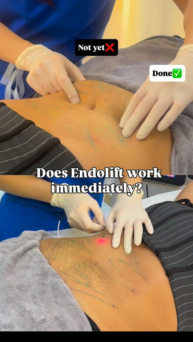 Does Endolift work immediately❓Yes—but here’s what you’re actually seeing 👇🏼
🟢Immediately after the procedure
You’ll usually notice an immediate tightening effect. At the same time, some swelling is expected, so what you see on day one is a combination of both.
🔺First 2–3 weeks
The immediate tightening is temporary and gradually fades as the swelling settles. This is completely normal and not your final result.
🔺From around week 3
Collagen remodeling gradually becomes more noticeable.
🔺Around 3 months
Most patients see the most visible improvement, although collagen remodeling can continue for several more months.
How long do the results last?
In most patients, the improvement lasts around 2–3 years, depending on factors such as age, skin quality, lifestyle, and future weight changes...
.
.
.
#endoliftdubai #endolift