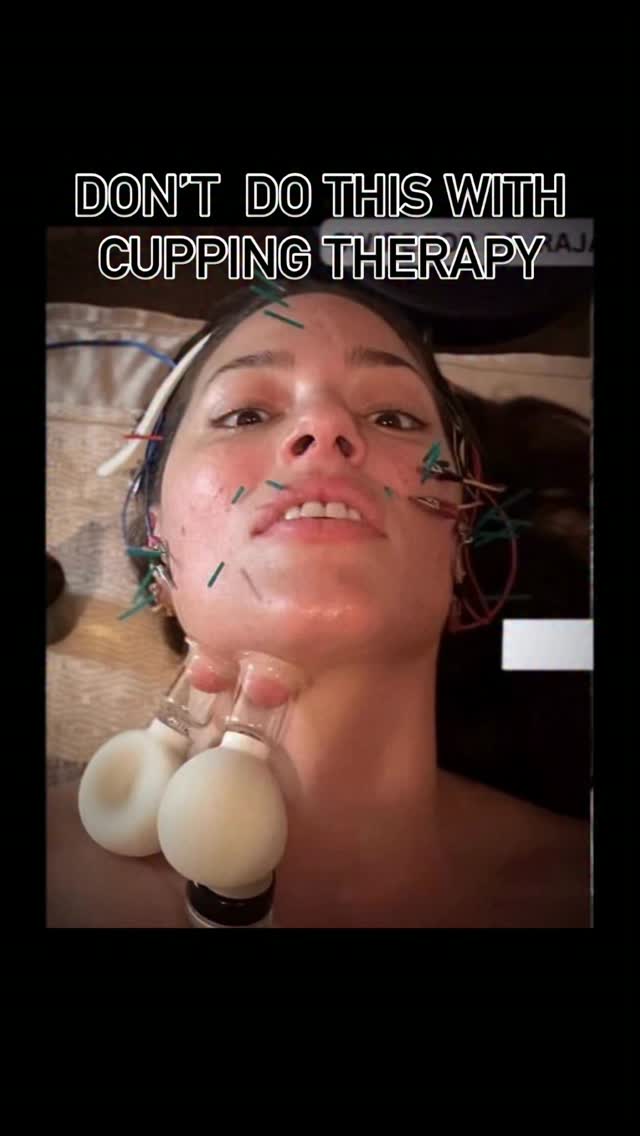 So, your new “advanced” cupping set has e-stim, heat, red light, and a Bluetooth speaker in it — cool. None of it does anything more than a basic cup at the appropriate pressure. Welcome to Cupception: a gimmick, wrapped in a gimmick, marketed really well, but lacking all the science.
⭕️
The red light therapy literature puts the therapeutic dose needed for the power emitted of a red light device at around 10-50 J/cm² for any measurable cellular effect at all. So let’s do the math on your $50 vibrating cup that puts out just “.06 J/s” of output according to the manufacturer. To hit even the low end of that window on a single cup’s contact area, you’re looking at leaving that cup on for the better part of an hour. Per cup. Times 15 cups, you’re not doing a treatment… that’s just excessive and negligent suction with a vibration motor and a good marketing team.
⭕️
Making marks and giving blisters is not the way to go. Do better. Otherwise, straight to jail… 🤡