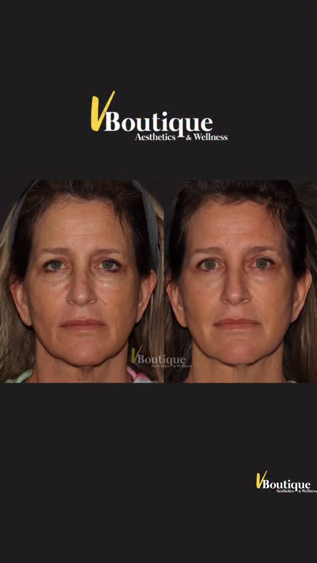 ✨ PRELIMINARY RESULTS — and we’re only 2 weeks in! ✨
These before-and-after images were taken just 2 weeks after our patient’s SECOND XERF treatment for the face. This is still very early: collagen remodeling and tissue tightening will continue to evolve over the next 3+ months, so we expect these results to get even better. We’ll share follow-up photos as her final result develops. 🤍
What are we already seeing? 👀
✨ More open, refreshed eyes with subtle brow lifting and improvement in under-eye bags
✨ Structural volumization of the cheeks — without a drop of filler or biostimulator
✨ Significant softening of the nasolabial folds and marionette lines
✨ Early jawline tightening and definition
✨ Smaller-looking pores, improved skin quality and that beautiful, healthy glow
Most importantly, she simply looks refreshed — not “done,” not overfilled, and still completely herself.
So what is XERF?
XERF is a new-generation Korean dual-frequency monopolar radiofrequency technology designed for deep, structural skin tightening. By delivering RF energy at different depths, including deeper tissue planes approaching the SMAS/fibroseptal support network, it creates controlled heating that stimulates collagen contraction and longer-term collagen remodeling — helping tighten, lift and improve the structural support of the face over time. 🔥
Best of all- there is zero down time and minimal discomfort!👍🏻
This patient has had no additional treatment during this period — no neuromodulators, no filler and no biostimulators.
Stay tuned for staked protocols where we combine XERF with other Lasers and injectables for optimal transformation based on YOUR individual needs.✨
#XERF #SkinTightening #Nonsurgicalfacelift #NaturalRejuvenation #CollagenRemodeling