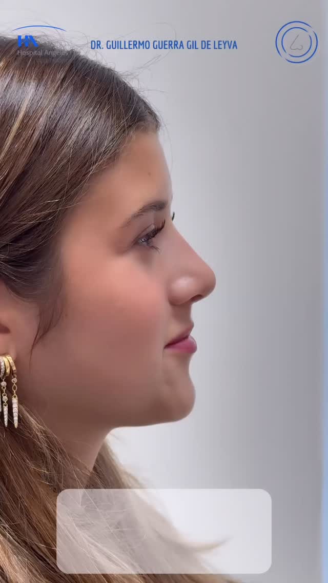 🔹 La Rinoplastia Personalizada se adapta a tu rostro, tus rasgos y tus expectativas. Natural, armónica y única.
🔹Evolución a un mes de Cirugía Nasal Estética y Funcional.
🔹 Gracias a mi excelente paciente por su confianza y permitir compartir su resultado.
🔹”Made by hand. Crafted with passion”
🧑⚕️ Dr. Guillermo Guerra Gil de Leyva
🏥 Hospital Ángeles Valle Oriente
📱 81-1252-0132
🎓Universidad de Monterrey
👃 Rinoplastia Estética y Funcional
🚫 No taponamiento
Cédula Profesional: 3070499
Cédula Especialista: 4503273
No. Certificación CONACEM: GUG-1748/04
Aviso de Publicidad COFEPRIS: 2419032002A00111
❕Paciente autoriza difusión de imágenes con fines académicos e informativos.
❕Los resultados finales se pudieran observar hasta un año de la cirugía y dependerá tanto del compromiso del cirujano como del paciente, así como del tipo de cirugía, tipo de piel, cuidados post-operatorios, etc.
#RinoplastiaPersonalizada #TuNarizTuEstilo
#rinoplastia #rhinoplasty #septoplastia septoplasty rinoseptumplastia rhinoseptoplasty nosejob nose nosesurgery tabiquenasal otorrinolaringologia entsurgery cirugianasal cirugiatabique cirugiaesteticanasal
belleza confianza autoestima
cosmeticsurgery
otorrinolaringologiamonterrey otorrinomonterrey beforeandafter antesydespues
estructuredrhinoplasty
rinoplastiaestructurada
rinoplastiaultrasonica
ultrasonicrhinoplasty