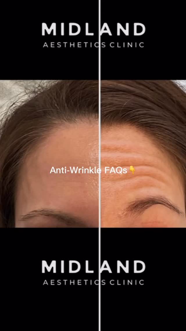 Anti-Wrinkle Treatment FAQs ✨
When will I see results?
Most people start noticing a change within a few days, with the full effect usually developing over around 2 weeks.
How long does it last?
Typically around 3–4 months, although this varies from person to person.
Will I look frozen?
Not necessarily. Treatment can be tailored to soften movement while still keeping the face looking natural and expressive.
What areas can be treated?
Common areas include the forehead, frown lines and crow’s feet, depending on your anatomy and treatment plan.
Does it hurt?
Most people describe it as a quick, mild pinprick sensation.
Is there downtime?
Usually very little. You may have small red marks, tenderness or occasional bruising after treatment.
Can I have a top-up?
Results should be reviewed once the treatment has fully settled. Any adjustment should be based on your individual response rather than automatically adding more. A free top up at 2 weeks is included
Is it suitable for everyone?
No. A consultation and medical assessment are important to check suitability, discuss expectations and make sure treatment is appropriate for you.
What makes a natural result?
Good dosing, correct placement and respecting your normal facial movement — the goal is usually to look fresher, not different.
#AntiWrinkleTreatment #NaturalAesthetics #FacialAesthetics #AestheticMedicine #MidlandMedicalSpa