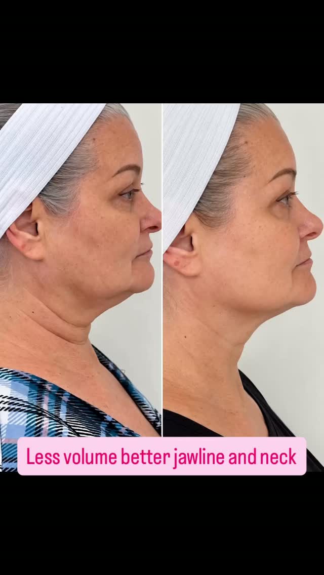 HIFU Jawline Lift ✨
Targets deeper layers to stimulate new collagen, helping to tighten loose skin, improve jawline definition, reduce the appearance of jowls, and create a firmer, more lifted lower face .
#sarasotaflorida #sarasotahifu #sarasota #capricebeautybar #siestakeybeach
Capricebeautybar.com
