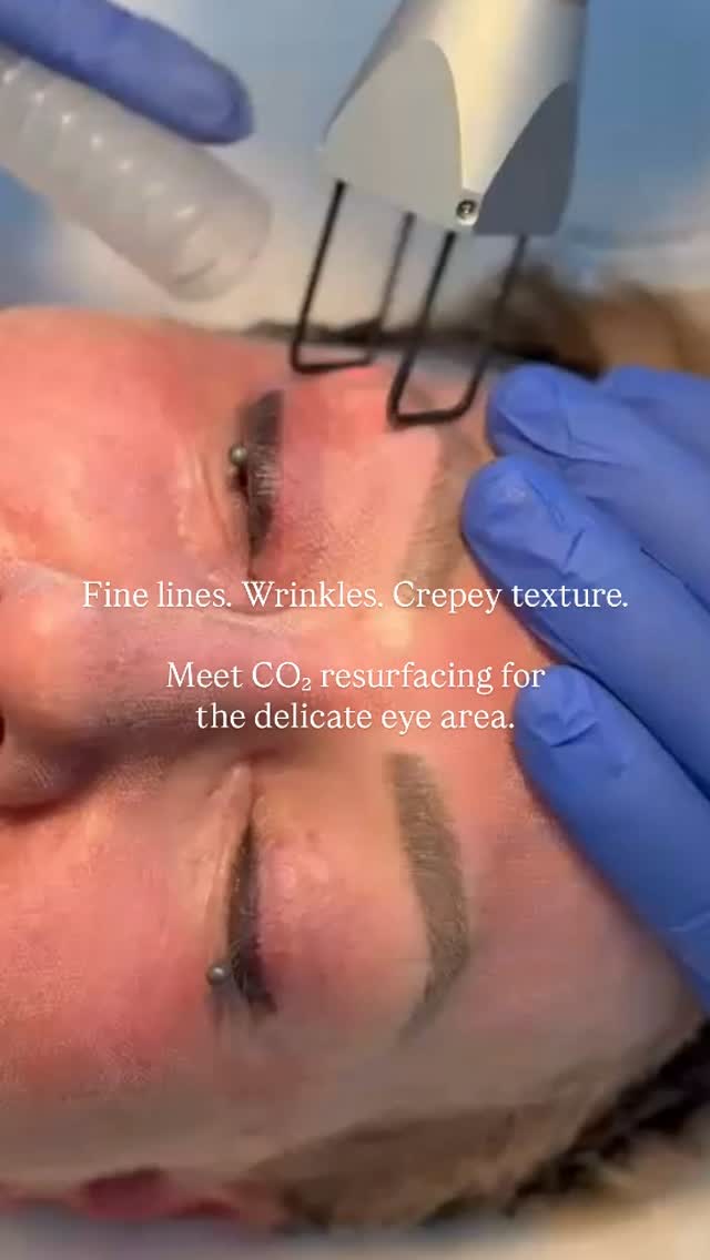 The delicate eye area deserves precision.
Using specialized ocular shields to protect the eyes, Dr. Ray can carefully perform CO₂ laser resurfacing around the orbital area to target fine lines, wrinkles and crepey texture. The controlled resurfacing response stimulates collagen remodeling, with improvements continuing to develop over the months that follow.
Precision matters - especially around the eyes.
Individual results and recovery vary. Treatment suitability is determined following an individual assessment.
📧 reception@viewlaser.com
💻 viewlaser.com
#skinrejuvenation #co2laser #delta #tsawwassen