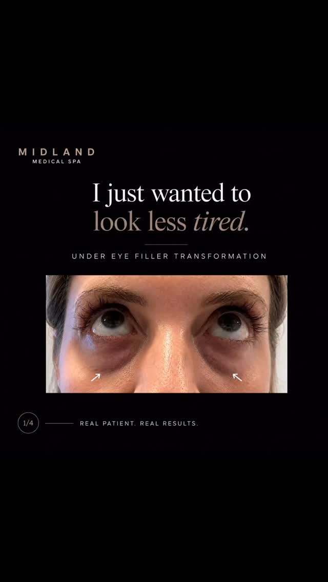 Under-eye dermal filler — subtle correction, not overfilling ✨
Under-eye filler can help soften tear-trough hollowing and improve the transition between the lower eyelid and cheek.
For the right patient, it may help:
• Reduce the appearance of hollowing
• Soften shadowing under the eyes
• Create a smoother lid-to-cheek transition
• Restore subtle support without adding unnecessary bulk
The key is careful patient selection and conservative placement.
Under-eye filler is not suitable for everyone, especially where there is significant puffiness, fluid retention or prominent eye bags. Sometimes another treatment is the better option.
The aim should be simple: look more rested, not “filled.”
#UnderEyeFiller #TearTroughFiller #DermalFillers #NaturalAesthetics #FacialRejuvenation