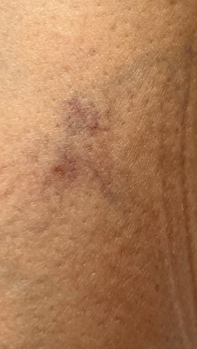 ✨ TURN SPIDER VEINS INTO A SKILL — NOT A GUESS
Sclerotherapy is so much more than injecting a visible spider vein.
To achieve predictable, safe results, you need to understand what’s feeding what.
🌿 The superficial veins
🌿 Reticular veins
🌿 Feeder veins
🌿 Perforators
🌿 The deeper venous system
Think of it as a tree — the telangiectasia may be the branches you can see, but the problem may begin further upstream.
That’s why our Microsclerotherapy Training focuses on the why behind the treatment, not simply where to put the needle.
You’ll learn how to assess the vascular pattern, recognise potential feeder veins, select an appropriate sclerosant and concentration, understand injection technique, and — crucially — know when NOT to treat.
Because beautiful results start with good anatomy, good assessment and good clinical judgement.
Whether you’re looking to add microsclerotherapy to your existing aesthetics practice or take your vascular knowledge to the next level, our training is designed to give you the understanding and practical confidence to treat responsibly.
📍 UK training
🎓 Professional training & certification
💉 Theory + practical training
👩🏫 Small-group, hands-on learning
✨ Suitable for practitioners meeting our entry requirements
Don’t just learn where to inject.
Learn what you’re actually treating.
DM SCLERO for course dates and information.
#SclerotherapyTraining #Microsclerotherapy #AestheticTraining #SpiderVeinTreatment #aestheticpractitioner