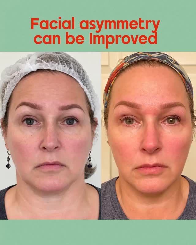 Rejuvenation means more to me than improving wrinkles or skin texture. When someone has visible facial asymmetry, even a small improvement in balance can make a meaningful difference.
My goal is never perfection-it is thoughtful, individualized care. Helping someone feel more confident is one of the most rewarding parts of my work.
#capricebeautybar #sarasotaflorida #age #hifu #skin
Capricebeautybar.com