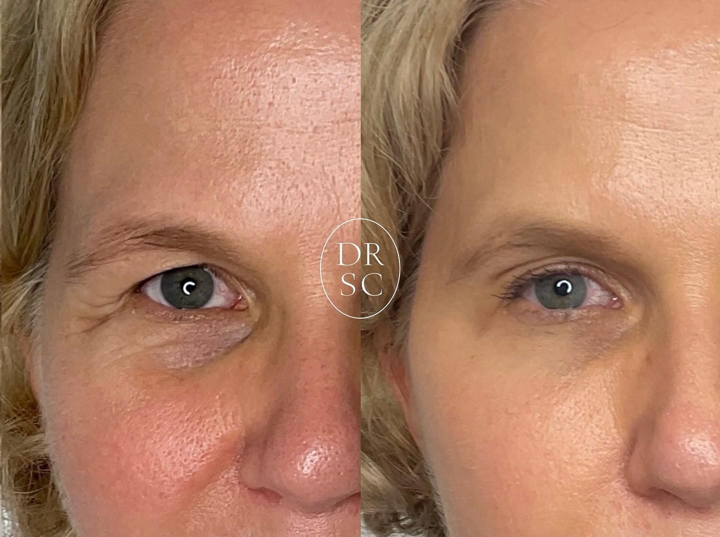 Open and Bright⭐️
A subtle and natural combination of carefully placed injectables to lift the eye and brightening skin lasers using our favourite GlowBEAM, Photo-Flash-Facial for radiance and even tone.
#laserbeauty #capetowndoctor #glow #beauty #glassskin #botox #fillers #IPL #Lasers