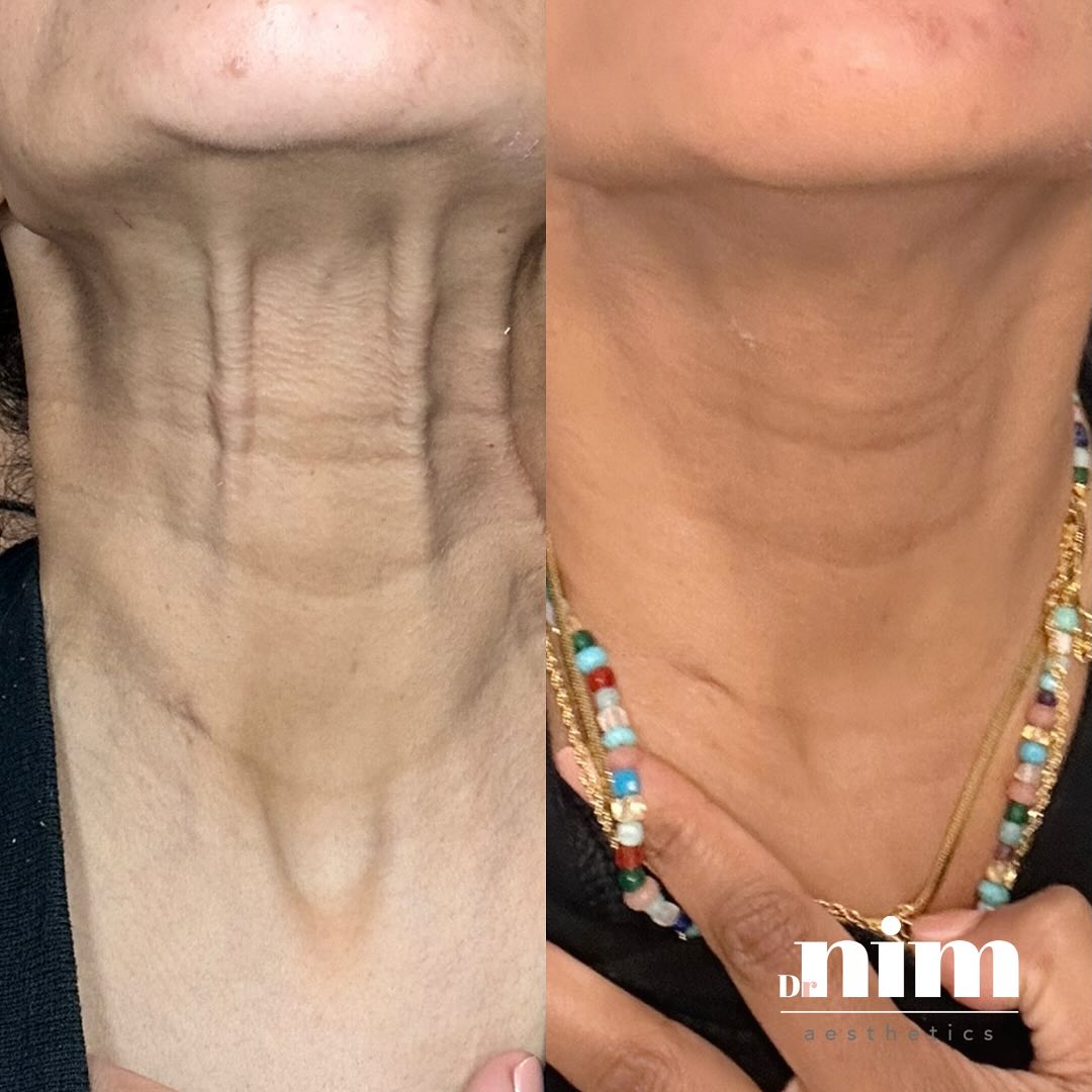 Look at this transformation! 🙌🏼
Vertical neck bands often given the appearance of loose skin on the neck, but we can provide a treatment that relaxes the pull of the muscle for a smoother and tighter looking neck.
We can even combine this treatment with skin boosters (such as Polynucleotides or Profhilo) for that added brightness and hydration 🤩
Interested in learning more? Drop me a DM for a complimentary consultation!
#liverpoolbeauty #youngerskin #youthfulappearance
