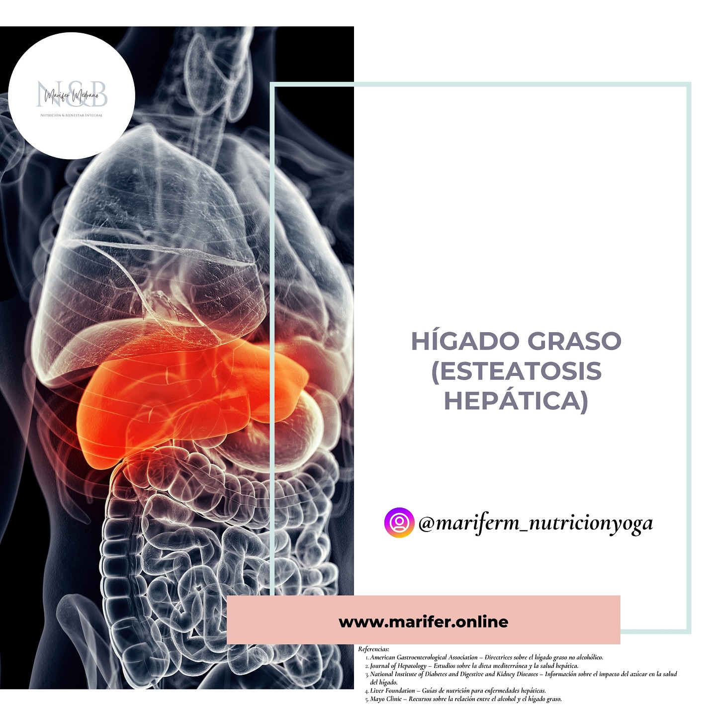 🌿 ¿Sabías que el hígado graso es una condición que puede mejorar con la alimentación?
La esteatosis hepática o hígado graso es cuando se acumula exceso de grasa en el hígado. Esto puede ser debido a factores como el sobrepeso, la diabetes y una dieta alta en azúcares y grasas poco saludables.
¿Por qué es clave una intervención nutricional? 🤔
Un cambio en la alimentación no solo ayuda a reducir la grasa acumulada en el hígado, sino que también puede mejorar tu energía, reducir la inflamación y prevenir complicaciones mayores como la cirrosis.
✨ Consejos básicos para una dieta saludable para el hígado:
🥗 Dieta rica en verduras y grasas saludables (como el aceite de oliva y el aguacate) para reducir la grasa hepática.
🍓 Evita azúcares y harinas refinadas. En su lugar, opta por frutas, granos enteros y alimentos sin procesar.
💪 Aumenta el consumo de proteínas de calidad como pescado, legumbres y frutos secos, que ayudan a mejorar tu composición corporal.
🍵 Di no al alcohol. El hígado graso no alcohólico (NAFLD) empeora con el consumo de alcohol.
Recuerda: cada caso es diferente y siempre es mejor contar con un plan personalizado que se ajuste a tus necesidades. Consulta con un profesional para un acompañamiento adecuado. 🌿✨ ¿Te gustaría más temas como este?