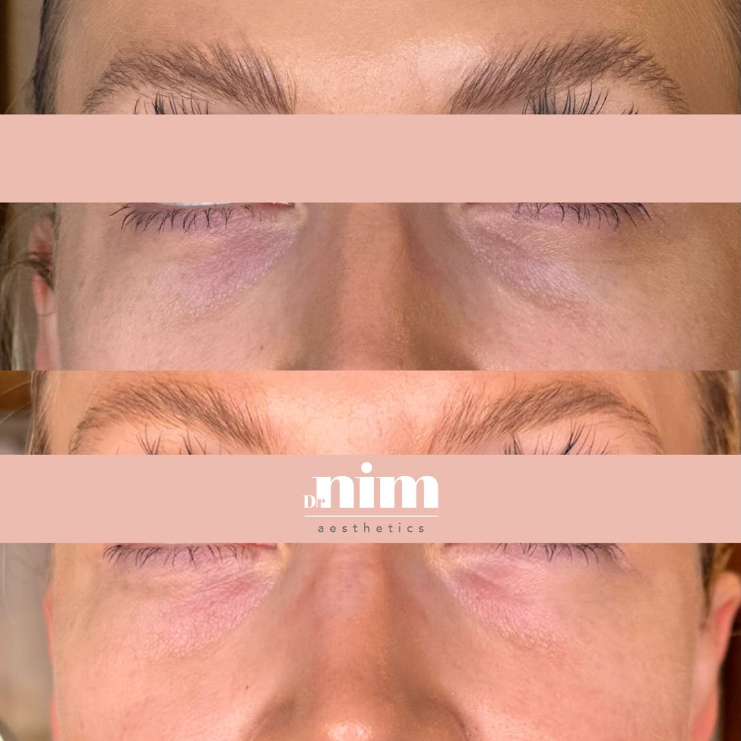 WOW! We are loving these under eye results after only one session of Polynucleotides! 😍
Polynucleotides are derived from salmon DNA. When injected into the skin they encourage your own body to produce higher concentrations of collagen and elastin.
It helps improve hollowing, fine lines, pigmentation, skin quality and tone.
Polynucleotides can be used anywhere on the body, but they are particularly popular for under the eyes - just take a look at our lovely client! Her under eye area looks brighter and more refreshed!
#polynucleotides #undereyes #eyetreatment #youthfulskin #finelines #greatskin