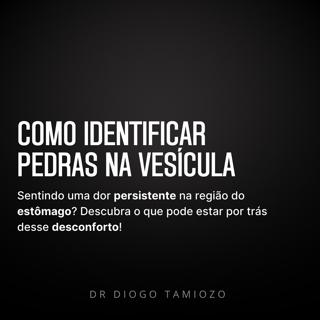 Você já sentiu uma dor persistente na região do estômago e não conseguiu identificar a causa? Muitas vezes, esses sintomas são confundidos com indigestão ou gastrite, mas também podem indicar algo mais sério, como pedras na vesícula.
Cálculos biliares, ou pedras na vesícula, são partículas sólidas que se formam na vesícula biliar, podendo causar desde desconforto até dores intensas. Os sintomas comuns incluem dor epigástrica (perto do estômago), dor no lado direito do abdômen, inchaço, náuseas e desconforto após refeições.
Se você apresenta esses sintomas com frequência, procure um médico. Exames, como a ultrassonografia, ajudam no diagnóstico, e o tratamento pode variar, desde ajustes na dieta até, em casos mais graves, a cirurgia. Não ignore os sinais do seu corpo!