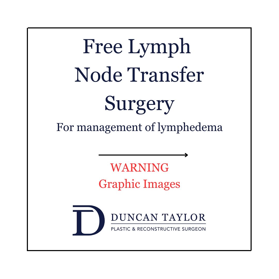 Vascularised free lymph node transfer from the neck to right groin + lymphatic anastomosis 
1. Pre Op 
2. 4 Weeks Post Op 
- Surgery aims to improve lymphedema symptoms, though it is not a cure - Patient had right groin dissection + radiation therapy 30+ years ago and has suffered with significant lymphedema since 
Surgery Performed by Dr Duncan Taylor (MED0001883464) Specialist Plastic & Reconstructive Surgeon.
🔹 Outcomes achieved in these photos are only relevant to this patient and do not necessarily reflect the results other patients may experience.
🔹There are inherent risks associated with any surgical or invasive procedures. The recovery period varies based on the specific procedure, and individual outcomes will differ.
🔹More information about risks and recovery for each procedure is available on our website www.drduncantaylor.com.au, on the procedure information sheets.
🔹We recommend getting a second opinion from a qualified health practitioner before proceeding.
🔹 This patient gave photo consent. 
#freelymphnodetransfer #lymphaticsurgeryperth #lymphedemaperth #perthlymphatic #perthlymphedema #lymphedemasurgery #lymphedematreatment