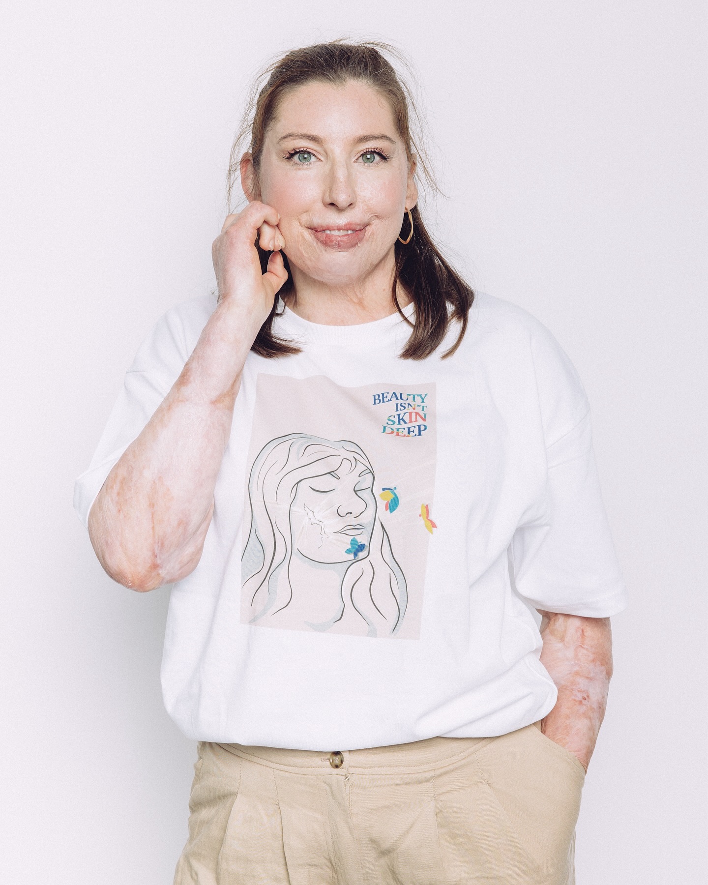 Beauty Isn’t Skin Deep ✨
•
Back with a gorgeous campaign celebrating visibility, uniqueness & strength! Created by @anthony.lexa in collaboration with @changingfacesuk with sustainable @teemillstore tees & hoodies!
•
Let’s embrace our scars, our skin, our stories. Being visible is an act of
strength, and it’s time we celebrate who we truly are! ✨
•
Want to buy this top or hoody and help supoort the campaign? Head to @anthony.lexa account and hit the link in the bio 💫