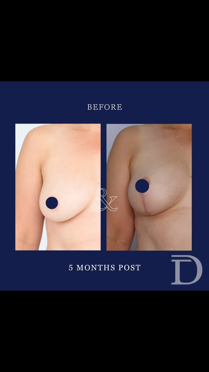 Mastopexy (breast lift) + fat grafting 
1. Pre Op
2. 5 months post op 
- Scars take 12 - 18 months to mature/ fade 
Surgery Performed by Dr Duncan Taylor (MED0001883464) Specialist Plastic & Reconstructive Surgeon.
🔹 Outcomes achieved in these photos are only relevant to this patient and do not necessarily reflect the results other patients may experience.
🔹There are inherent risks associated with any surgical or invasive procedures. The recovery period varies based on the specific procedure, and individual outcomes will differ.
🔹More information about risks and recovery for each procedure is available on our website www.drduncantaylor.com.au, on the procedure information sheets.
🔹We recommend getting a second opinion from a qualified health practitioner before proceeding.
🔹 This patient gave photo consent. 
#mastopexy #breastliftsurgery #breastliftperth #perthbreastlift #fatgraftingperth #perthfatgrafting #fatgraftingsurgery #breastsurgeryperth #perthbreastsurgery #perthcosmeticsurgery #cosmeticsurgeryperth #perthbreastaugmentation #breastaugmentationperth #plasticsurgeonperth #perthplasticsurgeon #perthplasticsurgery #plasticsurgeryperth #drduncantaylor