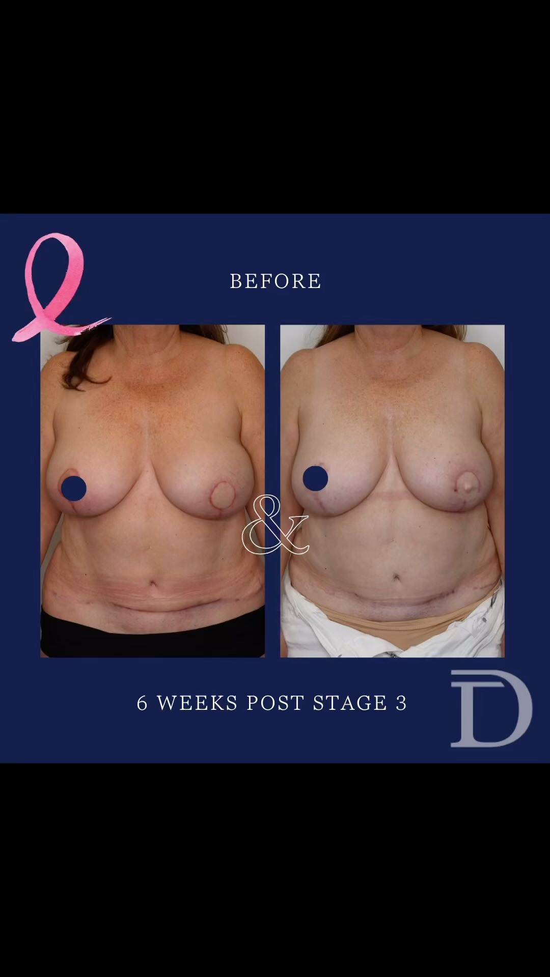 Left Mastectomy + DIEP Breast Reconstruction 
1. Pre Op 
2. 6 Weeks Post Nipple Reconstruction 
- Scars take 12 - 18 months to mature/ fade
- Aerolar tattooing to be completed 6 months post nipple reconstruction surgery 
- Revision surgeries are different for all patients, depending on desired outcomes. This patients surgeries outlined below: 
Stage 1 - Left Mastectomy + DIEP Breast Reconstruction
Stage 2 - Symmetrising Right Breast Reduction + Fat Grafting + Abdominal Scar Revision 
Stage 3 - Nipple Reconstruction 
Surgery Performed by Dr Duncan Taylor (MED0001883464) Specialist Plastic & Reconstructive Surgeon.
🔹 Outcomes achieved in these photos are only relevant to this patient and do not necessarily reflect the results other patients may experience.
🔹There are inherent risks associated with any surgical or invasive procedures. The recovery period varies based on the specific procedure, and individual outcomes will differ.
🔹More information about risks and recovery for each procedure is available on our website www.drduncantaylor.com.au, on the procedure information sheets.
🔹We recommend getting a second opinion from a qualified health practitioner before proceeding.
🔹 This patient gave photo consent. 
#autologousbreastereconstruction #diepbreastreconstruction #unilateraldiepflap #unilateralmastectomy #perthbreastreconstruction #breastreconstructionperth #nipplereconstructionsurgery #perthbreastcancer #breastcancerperth #perthplasticsurgeon #plasticsurgeonperth #plasticsurgeryperth #perthplasticsurgery #specialistplasticsurgeon