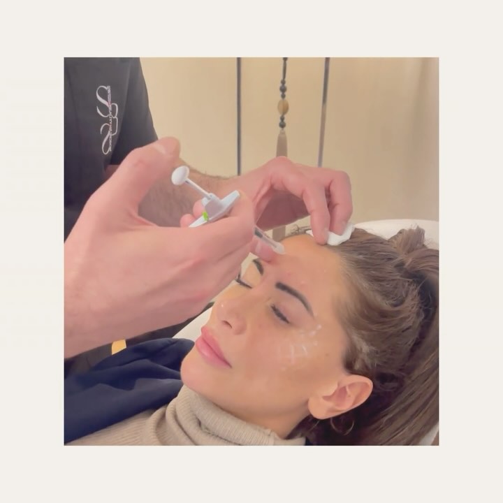 🎥 Live Botox Session with Dr. Veber!💉✨
Rejoignez-nous en direct pour une “session exclusive de Botox” avec le Dr. Veber sur l’une de ses patientes ! 🌟 Découvrez comment se déroule une véritable injection de Botox, étape par étape, et obtenez toutes les réponses à vos questions sur cette procédure populaire. 💬
👉 Ce que vous verrez
1️⃣ Une démonstration en direct de l’injection de Botox.
2️⃣ Les techniques du Dr. Veber pour garantir des résultats naturels et harmonieux.
3️⃣ Conseils et explications sur les zones ciblées et les bénéfices du Botox.
Que vous soyez curieux(se) ou que vous envisagiez un traitement, c’est l’occasion idéale d’en savoir plus et de découvrir l’expertise du Dr. Veber en action ! 💫
🎥 Live Botox Session with Dr. Veber!💉✨
Join us for an “exclusive live Botox session” with Dr. Veber on one of his patients! 🌟 Watch the full process of a Botox injection, step by step, and get all your questions answered about this popular procedure. 💬
👉 What you’ll see
1️⃣ A live demonstration of Botox injections.
2️⃣ Dr. Veber’s techniques to ensure natural and harmonious results.
3️⃣ Tips and explanations on targeted areas and the benefits of Botox.
Whether you’re curious or considering a treatment, this is the perfect opportunity to learn more and witness Dr. Veber’s expertise in action! 💫
#LiveSession #BotoxLive #DrVeber #BotoxDemo #AestheticMedicine #NaturalResults #AskTheExpert