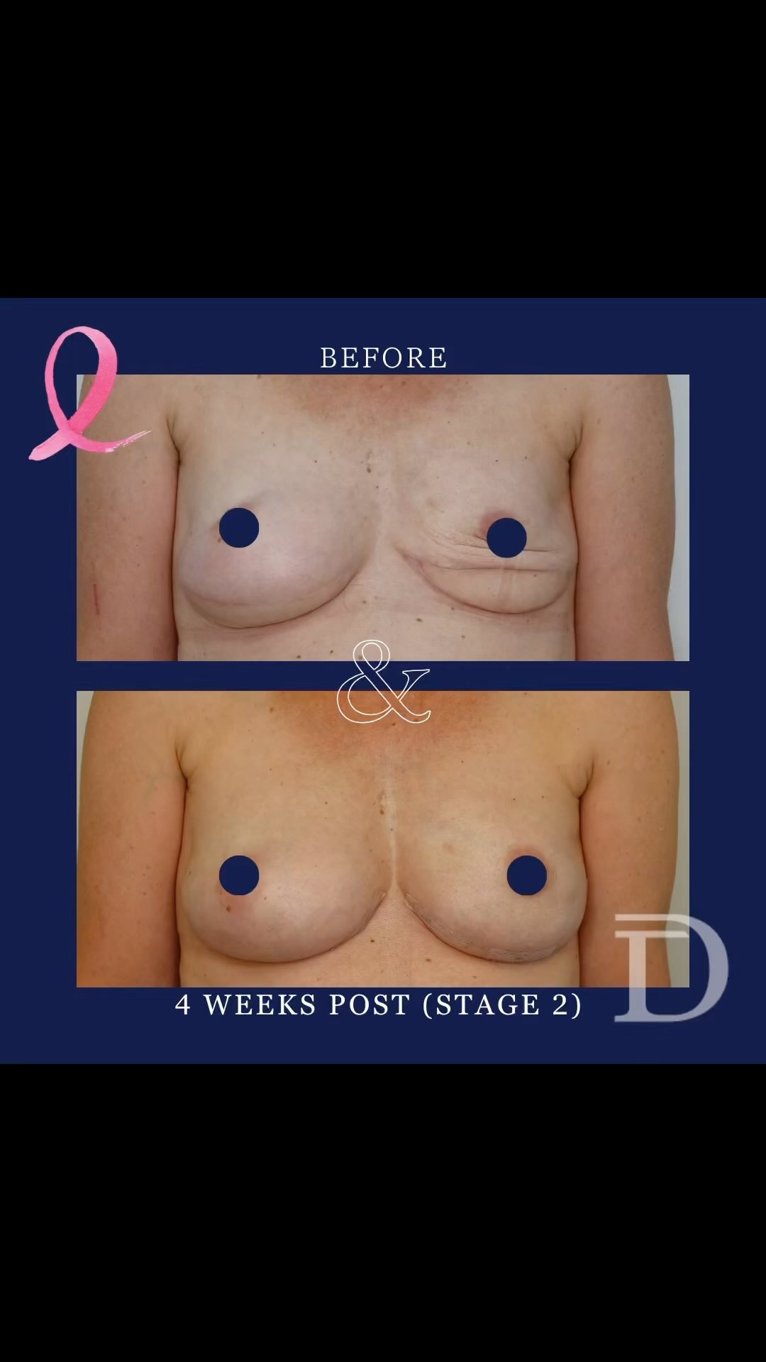 Open Revision + Fat Grafting Surgery, following a Bilateral Stacked PAP/ DIEP Breast Reconstruction. 
1. Pre Revision Surgery 
2. 4 Weeks Post Revision 
 - Scars take 12 - 18 months to mature/ fade
- Patient was very slim with minimal tissue available for an autologous reconstruction. Abdominal tissue (DIEP) and upper thigh tissue (PAP) microsurgically transplanted into breast pocket, for maximum volume. 
- Secondary procedure to build up volume and revise breast shape
Surgery Performed by Dr Duncan Taylor (MED0001883464) Specialist Plastic & Reconstructive Surgeon.
🔹 Outcomes achieved in these photos are only relevant to this patient and do not necessarily reflect the results other patients may experience.
🔹There are inherent risks associated with any surgical or invasive procedures. The recovery period varies based on the specific procedure, and individual outcomes will differ.
🔹More information about risks and recovery for each procedure is available on our website www.drduncantaylor.com.au, on the procedure information sheets.
🔹We recommend getting a second opinion from a qualified health practitioner before proceeding.
🔹 This patient gave photo consent.  #autologousbreastreconstruction #fatgrafting #perthbreastcancer #breastcancerreconstruction #perthplasticsurgeon #plasticsurgeonperth #specialistplasticsurgeon #microsurgicalreconstruction #owntissuereconstruction