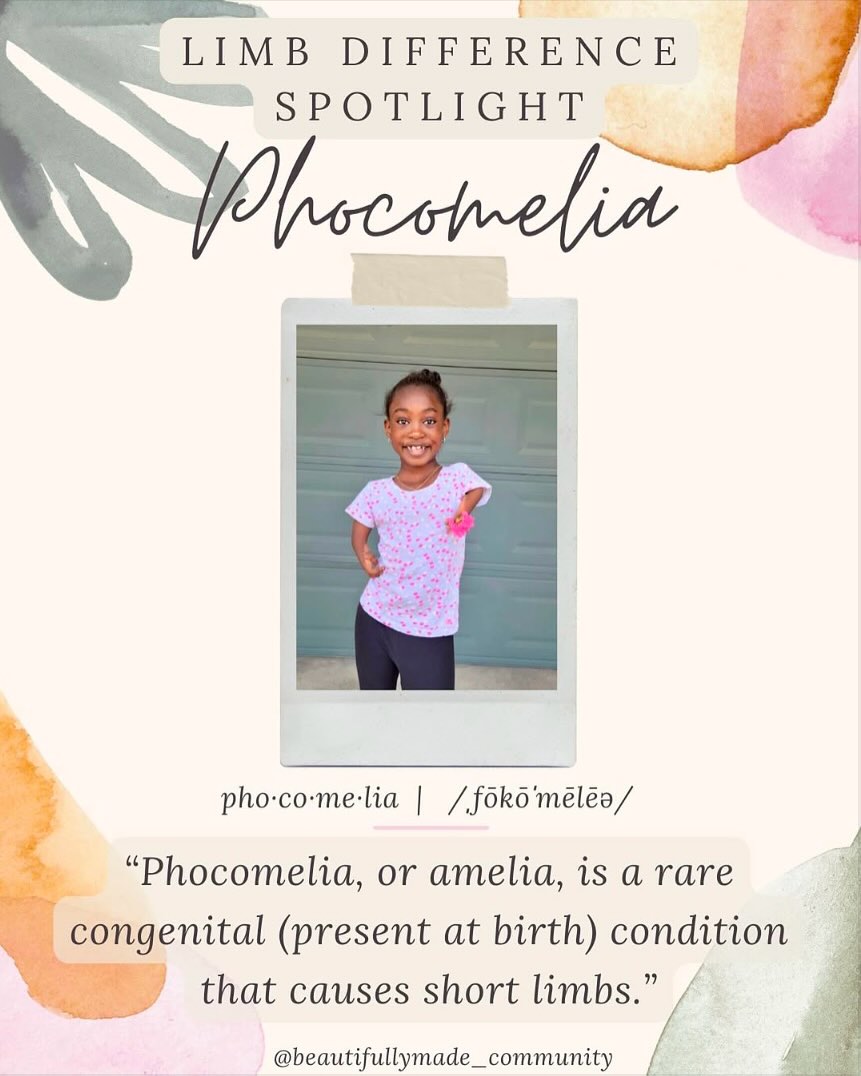 ✨Limb Difference Spotlight✨
Phocomelia is a rare birth difference that can affect the upper and/or lower limbs. The bones of the affected limb are either missing or underdeveloped. The limb is shortened and in some cases, the hand or foot may be attached directly to the trunk. Phocomelia can be responsible for the absence of pelvic and thigh bones. Fingers and toes may also be fused together.
If all four limbs are absent, it’s called tetraphocomelia. “Tetra” means four, “phoco” means seal, and “melos” means limb. This term refers to the ways the hands and feet appear. The hands may be attached to the shoulders, while the feet may be attached to the pelvis.
If desired, upper and lower extremity prosthetics are available for as early as six months of age.
✨RESOURCES✨
▫️Facebook-
🔎 “Lucky Fin Project”
🔎 “https://www.facebook.com/amazinginioluwa”
▫️Instagram-
@amazinginioluwa
@andreas.bradenberger
▫️Websites-
▪️ https://rarediseases.org/gard-rare-disease/phocomelia/
▪️ https://www.stlouischildrens.org/conditions-treatments/phocomelia
▪️ https://www.tgh.org/institutes-and-services/conditions/phocomelia
▪️ https://www.healthline.com/health/phocomelia
————————————————————————————
If you have any other resources pertaining to Phocomelia please feel free to leave yourself or another page in the comments.
•
•
#beautifullymadecommunity #beautiful #educate #inclusion #awareness
#kindnessmatters #luckyfinproject #beautifullymade #luckyfinsrock #representationmatters #limbdifferenceawareness #luckyfin #disabilityawareness #awareness #education #representation #positivity #inclusion #connect #resources #differentisbeautiful
#strong #inclusiveeducation #limbdifferencespotlight