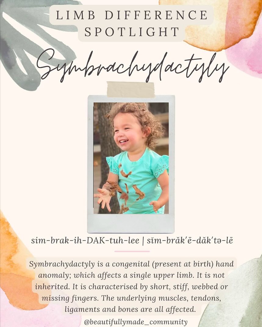 ✨Limb Difference Spotlight✨
Symbrachydactyly has been subdivided by Blauth and Gekeler (see NIH study) into 4 types:
* (1) Short finger (brachymesophalangia): all 4 fingers are short and incompletely formed with a relatively normal thumb; middle phalanges may be missing with incomplete syndactyly.
(2) Oligodactylic (atypical cleft hand): the central portion of the hand is aplastic, whereas the borders digits are less severely affected.
(3) Monodactylic: the fingers are absent or aplastic, whereas the thumb is present.
(4) Peromelic: resembles a transverse amputation at the metacarpophalangeal joint level, may have nubbins with or without nail remnants.
In most cases, children born with symbrachydactyly are able to adapt to their physical limitations and experience a fully functional life with no treatment.
Edit to add: Symbrachydactyly can also affect the feet which we will cover during Lower Limb Difference Spotlight.
✨RESOURCES✨
▫️Facebook:
- Helping Hands (Symbrachydactyly)
https://www.facebook.com/groups/21843487131/?ref=share
▫️Instagram:
@aussiehands
@campnolimits
@koalaacommunity
@handstoloveofficial
@grip_uf
@lucky_fin_project
@the_hhp
@nolimbitations_tx
@mad4minnie
@hdgreaser
@koalaacommunity
@reachcharity1
@thehandweredealt
▫️Websites:
- https://www.jhandsurg.org/article/S0363-5023(15)00829-1/fulltext
- https://www.ncbi.nlm.nih.gov/pmc/articles/PMC5030846/
-https://luckyfinproject.org
-https://aussiehands.org
-https://www.helpinghandproject.org
-https://nolimbitationstx.org/
-https://www.yourkoalaa.com
-https://reach.org.uk
————————————————————————
If you have any other resources pertaining to Symbrachydactyly please feel free to leave yourself or another page in the comments. 🤍
•
•
#beautifullymadecommunity #kindnessmatters #symbrachydactyly #beautifullymade #luckyfinsrock #representationmatters #limbdifferenceawareness #luckyfin #disabilityawareness #awareness #education #representation #inclusion #beautiful #inclusiveeducation #kindness #share #spreadawareness #shareyourstory #connect #resources #differentisbeautiful #limbdifferencespotlight