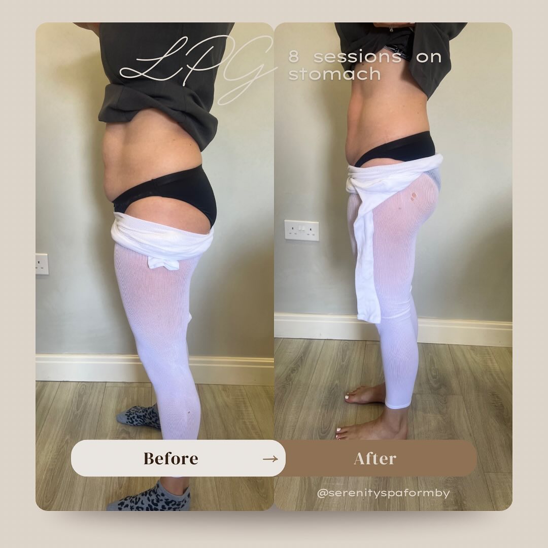 Ready to kick start your New Year with healthy eating, diet and exercise?.
This is client results after 8 sessions of Endermologie on the stomach area. Treatment time was 15minutes. This treatment has to be taken 2-3 times per week.
LPG Endermologie - Endermologie is the only technique in the world that naturally
- Removes fat which is resistant to diet
- Smooths cellulite
- Firms up the skin
Available for both face and body. Results are amazing.
For more information send a message or contact the salon from Monday 6th January.
#lpg #endermologie #fatloss #newyearnewme #lpgendermologie #liverpool #formby #weightloss #beautytips