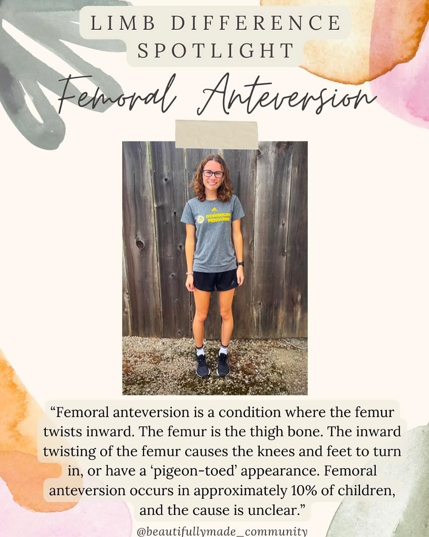 ✨Limb Difference Spotlight✨
Femoral Anteversion
“Femoral anteversion is a condition where the femur (thigh bone) twists inward. The inward twisting of the femur causes the knees and feet to turn inward. Femoral anteversion occurs in approximately 10% of children, and the cause is unclear. Femoral anteversion often resolves on its own as the child grows and does not necessitate treatment. In more severe cases that do not self-correct by age 8 or 9 years old, treatment may involve bracing and special shoes aimed at correcting the foot position, or surgery to rotate the femur to a better position.”
✨RESOURCES✨
▫️Instagram-
@alignedk8
▫️Websites-
▪️ https://www.childrenshospital.org/conditions/femoral-anteversion#:~:text=Femoral%20anteversion%20is%20an%20inward,is%20also%20called%20in%2Dtoeing.
▪️ https://www.chop.edu/conditions-diseases/femoral-anteversion
▪️ https://medical-dictionary.thefreedictionary.com/femoral+anteversion
————————————————————————————
If you have any other resources pertaining to femoral anteversion please feel free to leave yourself or another page in the comments.
•
•
#beautifullymadecommunity #beautiful
#kindnessmatters #beautifullymade #representationmatters #limbdifference #limbdifferenceawareness #luckyfin #disabilityawareness #awareness #education #representation #positivity #inclusion #connect #resources #differentisbeautiful #educate
#strong #inclusiveeducation #FemoralAnteversion